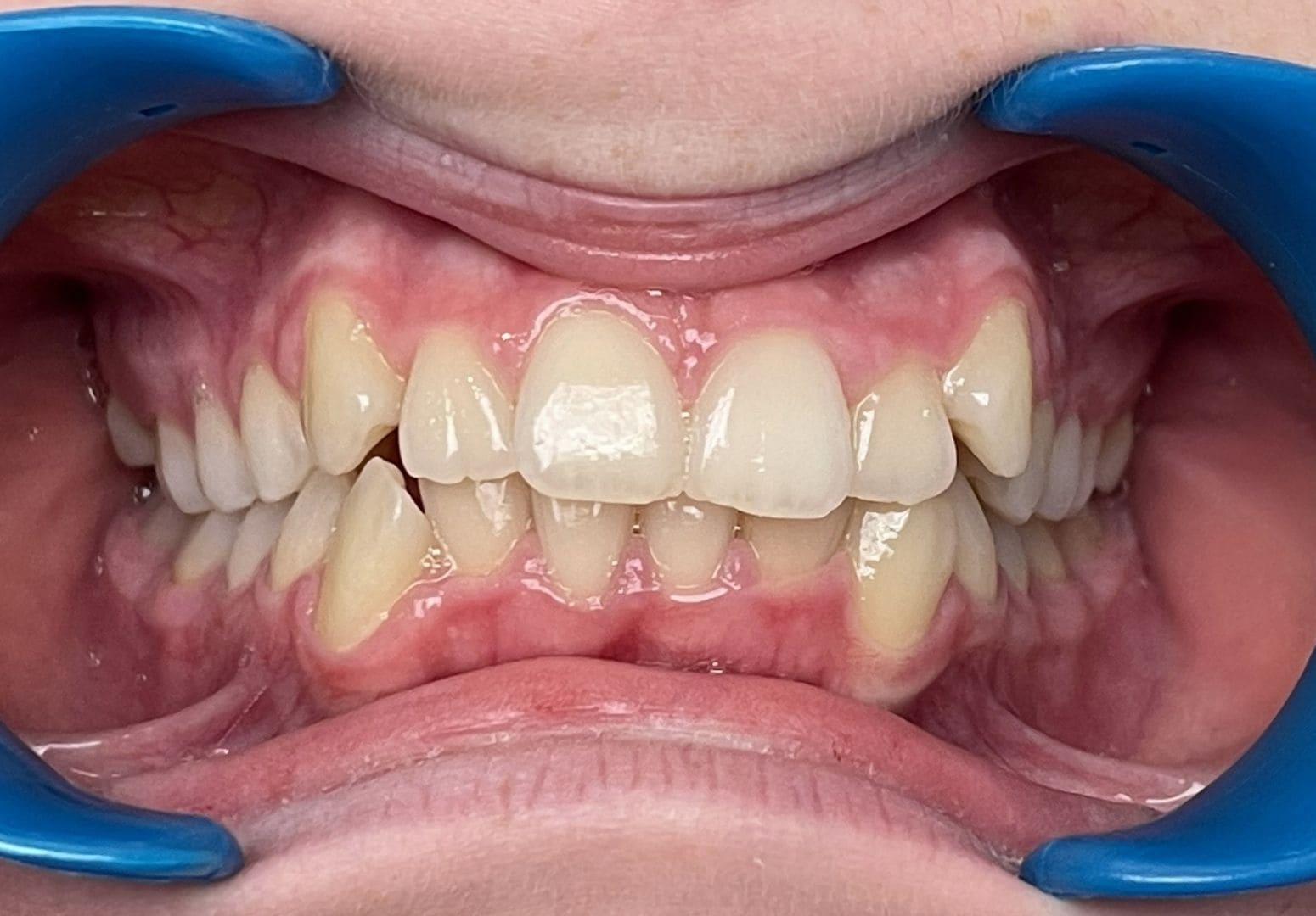 Cas n°1 — avant traitement orthodontique — Vue frontale — cas 1