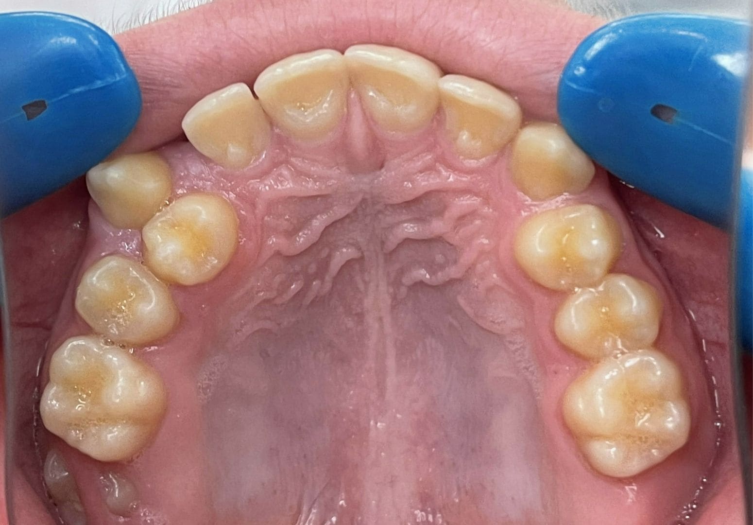 Cas n°2 — avant traitement orthodontique — Vue occlusale — cas 2