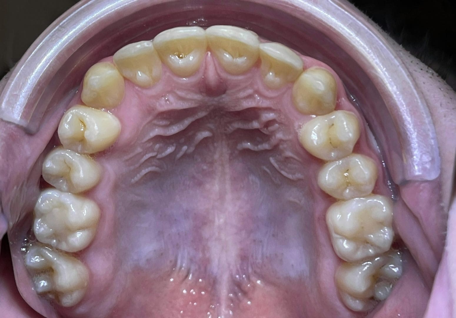 Cas n°2 — après traitement orthodontique — Vue occlusale — cas 2