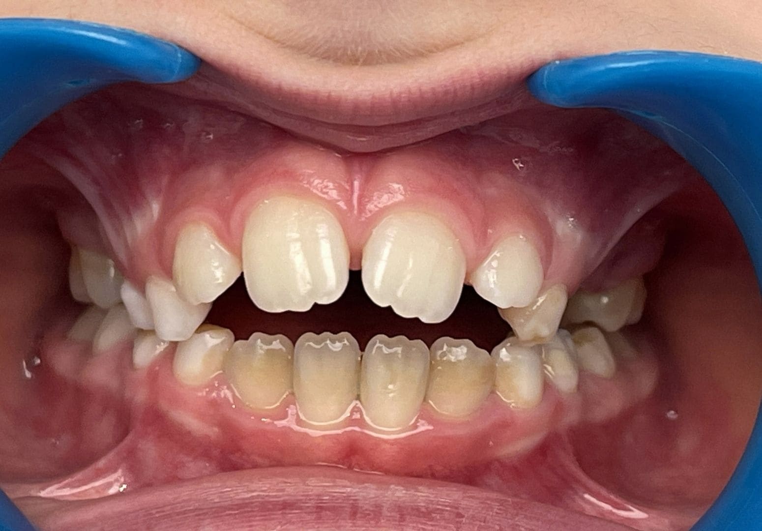 Cas n°3 — avant traitement orthodontique — Vue frontale — cas 3