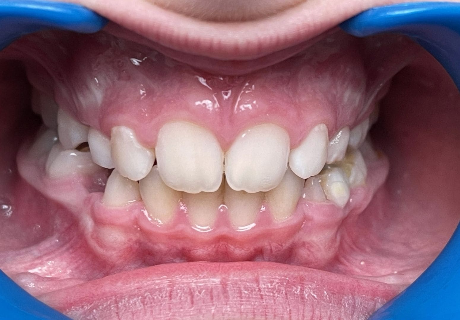 Cas n°3 — après traitement orthodontique — Vue frontale — cas 3